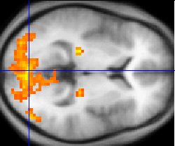 Magnetic resonance imaging
