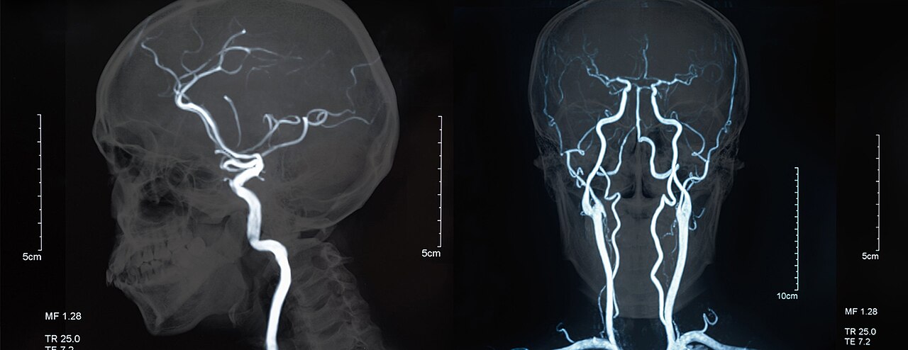 Magnetic resonance imaging