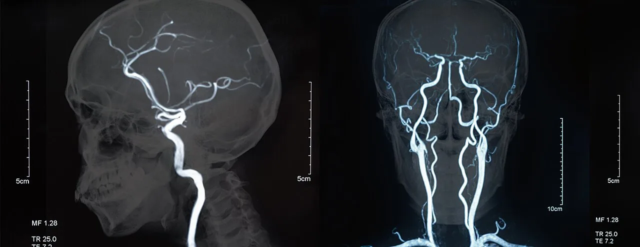 Magnetic resonance imaging